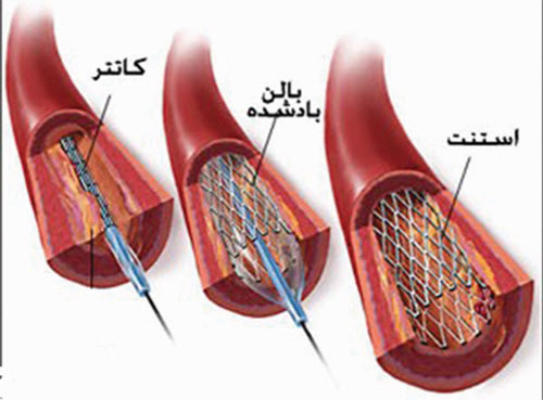 درج محیطی كاتتر مركزی